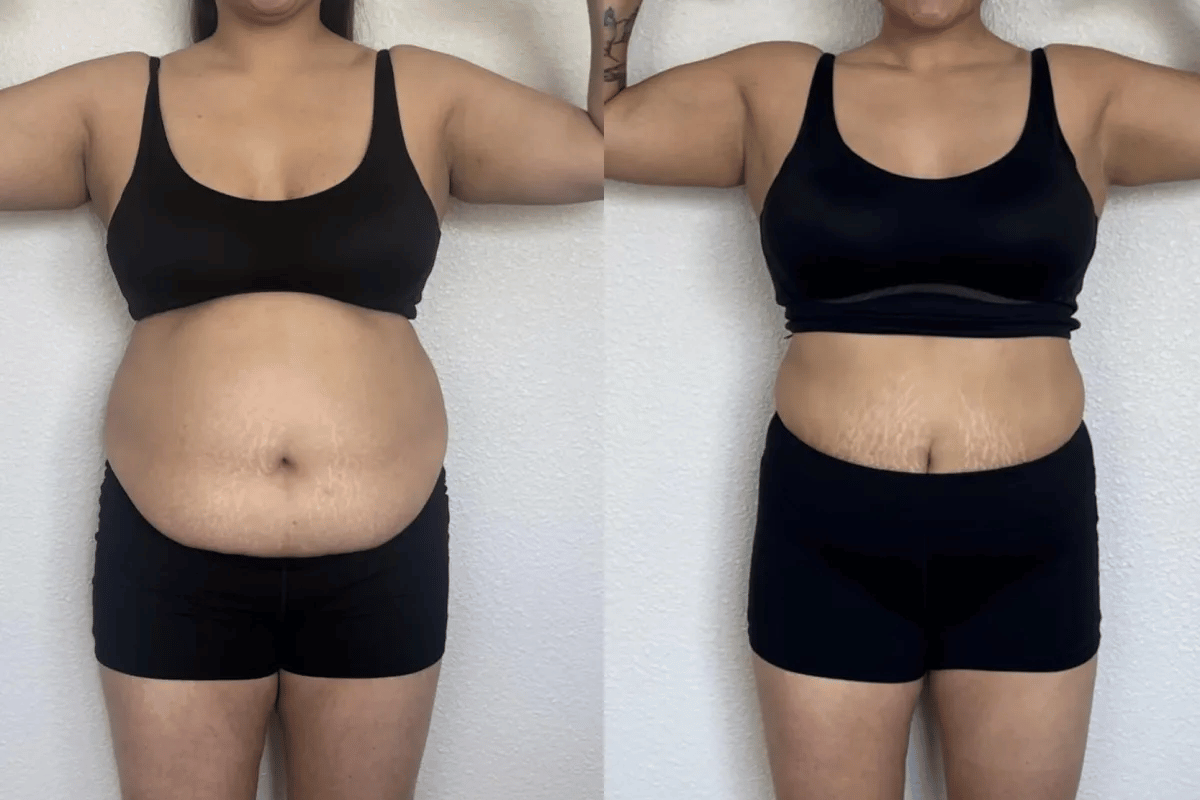 does tirzepatide slow your metabolism New Cleveland Clinic research finds tirzepatide is associated with a 16%  lower risk of major heart and kidney complications compared with  dulaglutide in people with Type 2 diabetes and heart disease. The