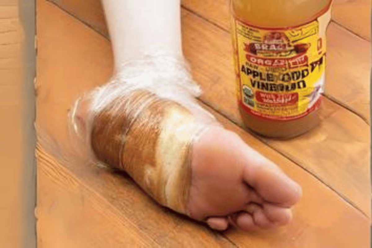 apple cider vinegar on feet overnight for weight loss