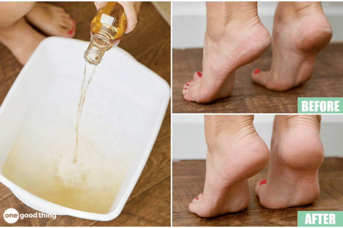 soaking feet in apple cider vinegar and baking soda for weight loss